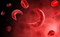 Sickle Cell study