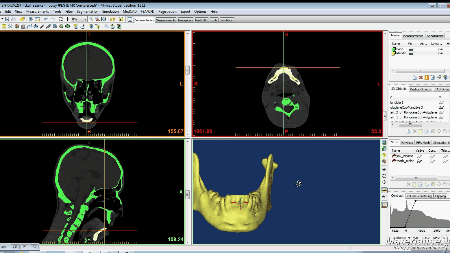 Animated gif of Virtual Surgial Simulation on the Human Jaw. graphic shows a 3D scan of a human jaw being repositioned in the lower right viewfinder. 