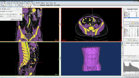 Photo of 3D CT-Image Reconstruction. Bottom right view shows a variety of anatomical locations of nerve bundles in the abodomen/pelvis. 