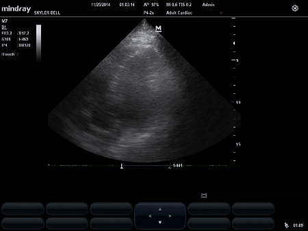Animated GIF of an ecocardiogram (Ultrasound of the heart). 