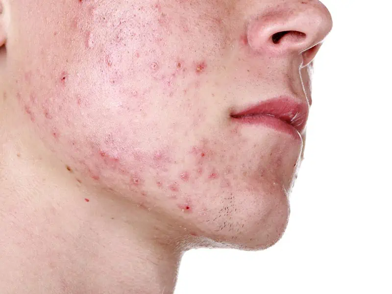 Close-up of a person’s lower face showing red acne and pimples on the cheek and jawline.