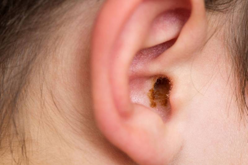 Earwax Ear with earwax in it